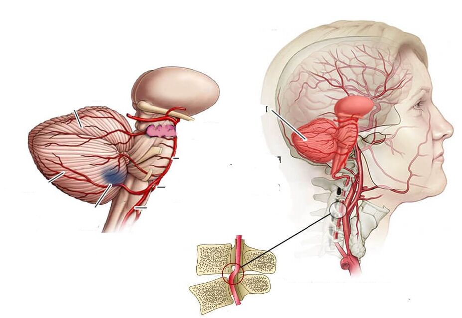 Ischemia cerebellar